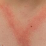 How do i cook for someone with a nickel allergy